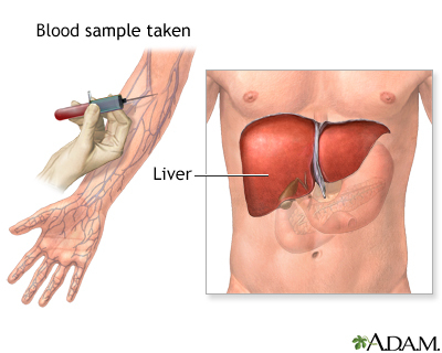 Laboratory technician analyzing a blood sample for an albumin test to evaluate liver and kidney function