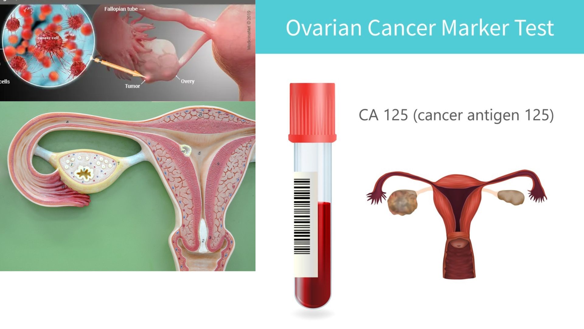 CA-125 blood test illustration with test tube, ovaries, and cancer awareness ribbon in a medical blog style.