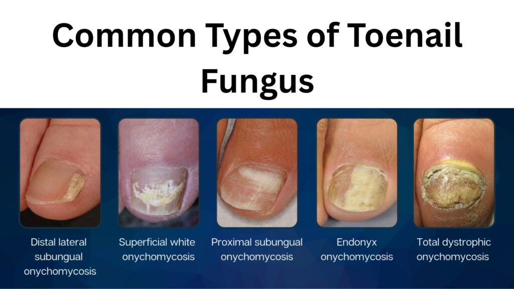 Close-up of a human foot showing toenails affected by fungal infection with thickened, yellowish, and brittle nails
