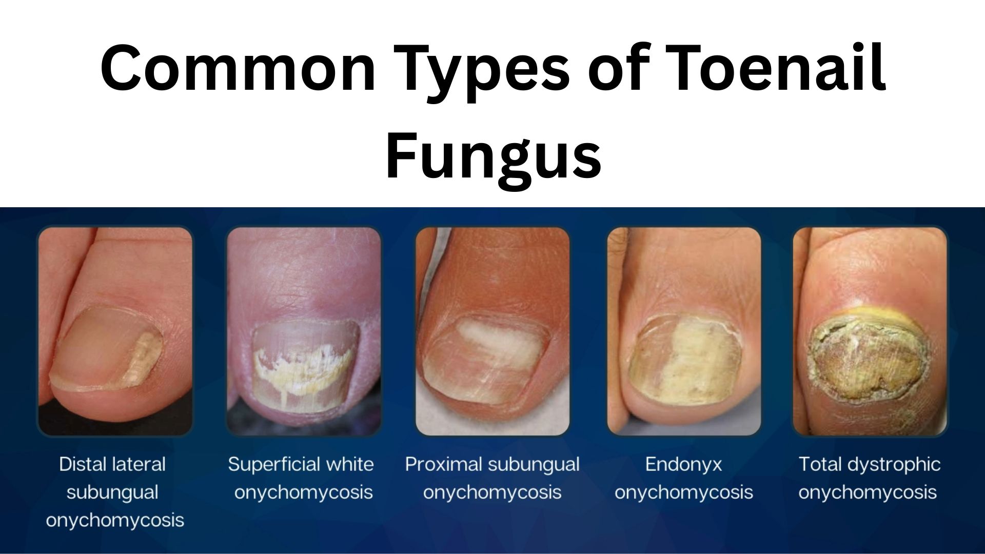 Close-up of a human foot showing toenails affected by fungal infection with thickened, yellowish, and brittle nails