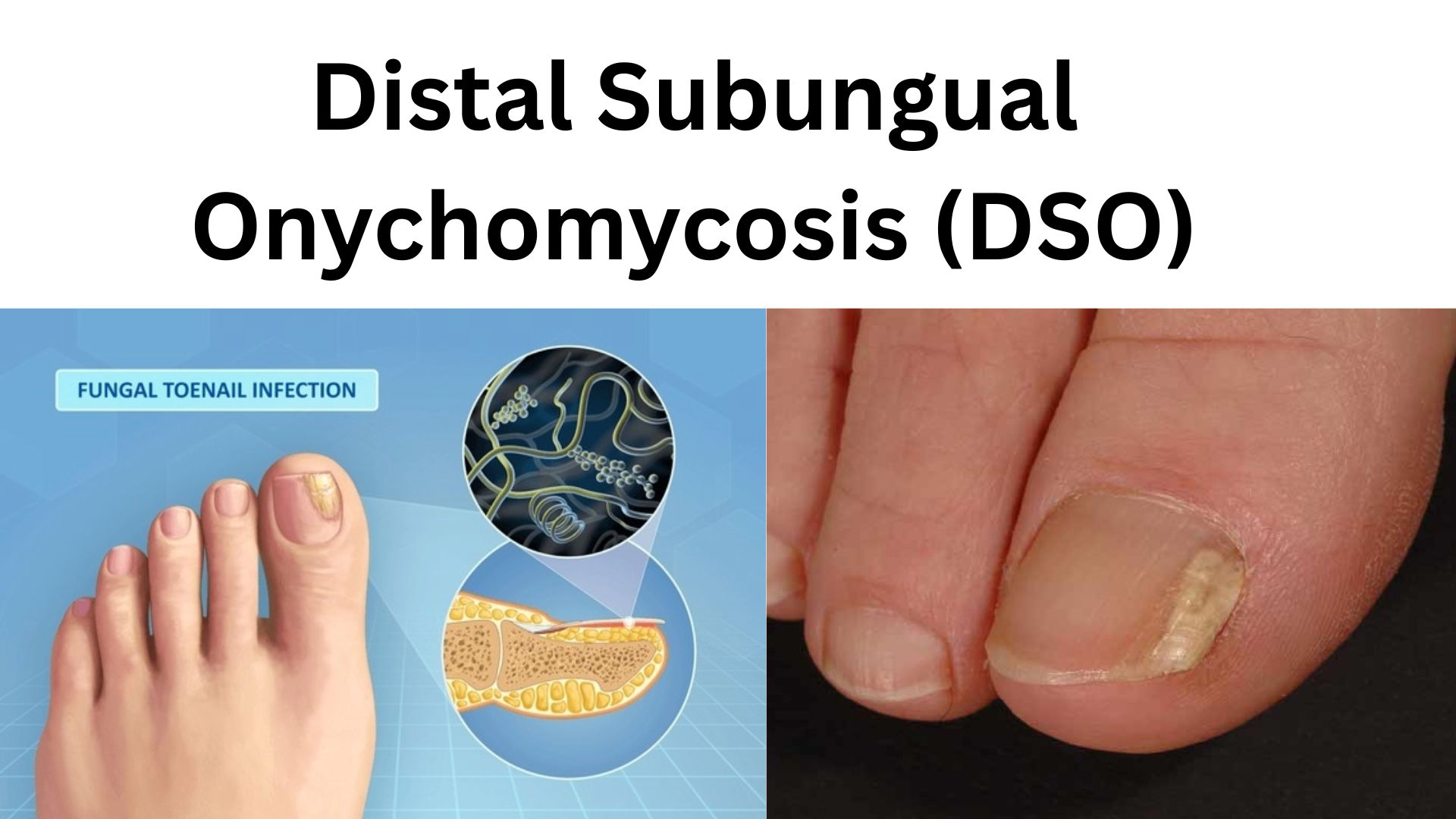 Close-up of a toenail affected by Distal Subungual Onychomycosis showing yellow discoloration, thickening, and nail plate separation from the nail bed