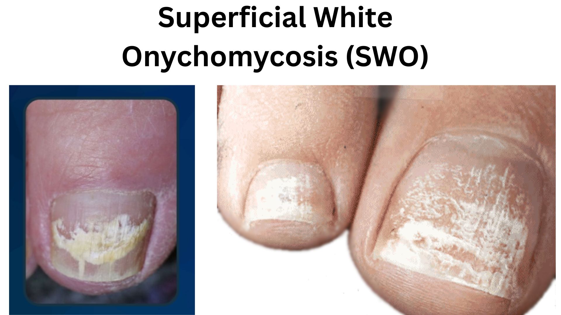 Close-up of a toenail affected by Superficial White Onychomycosis showing white powdery spots on the nail surface