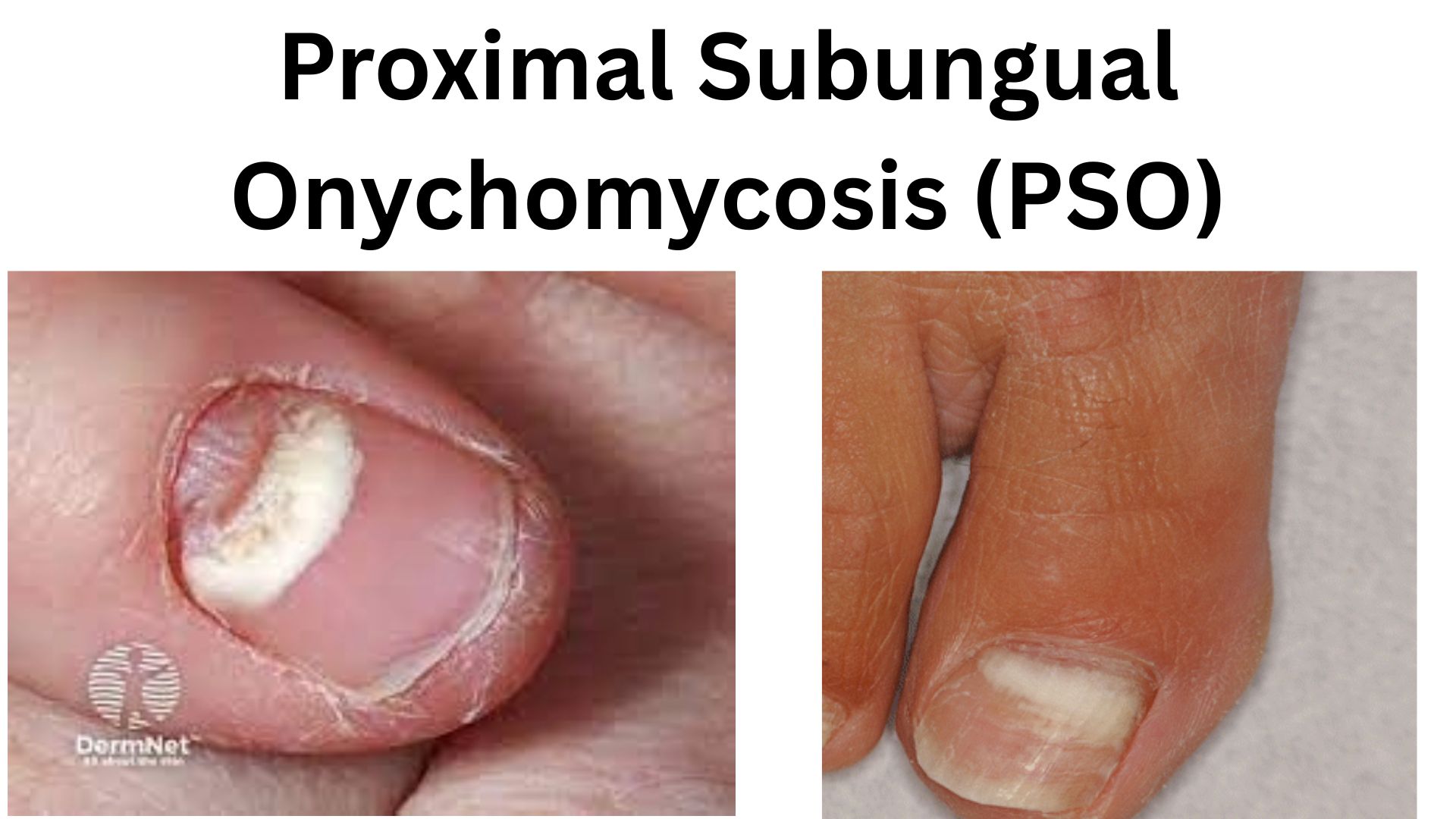 Close-up of a toenail affected by Proximal Subungual Onychomycosis showing thickened nail and discoloration starting from the base near the cuticle