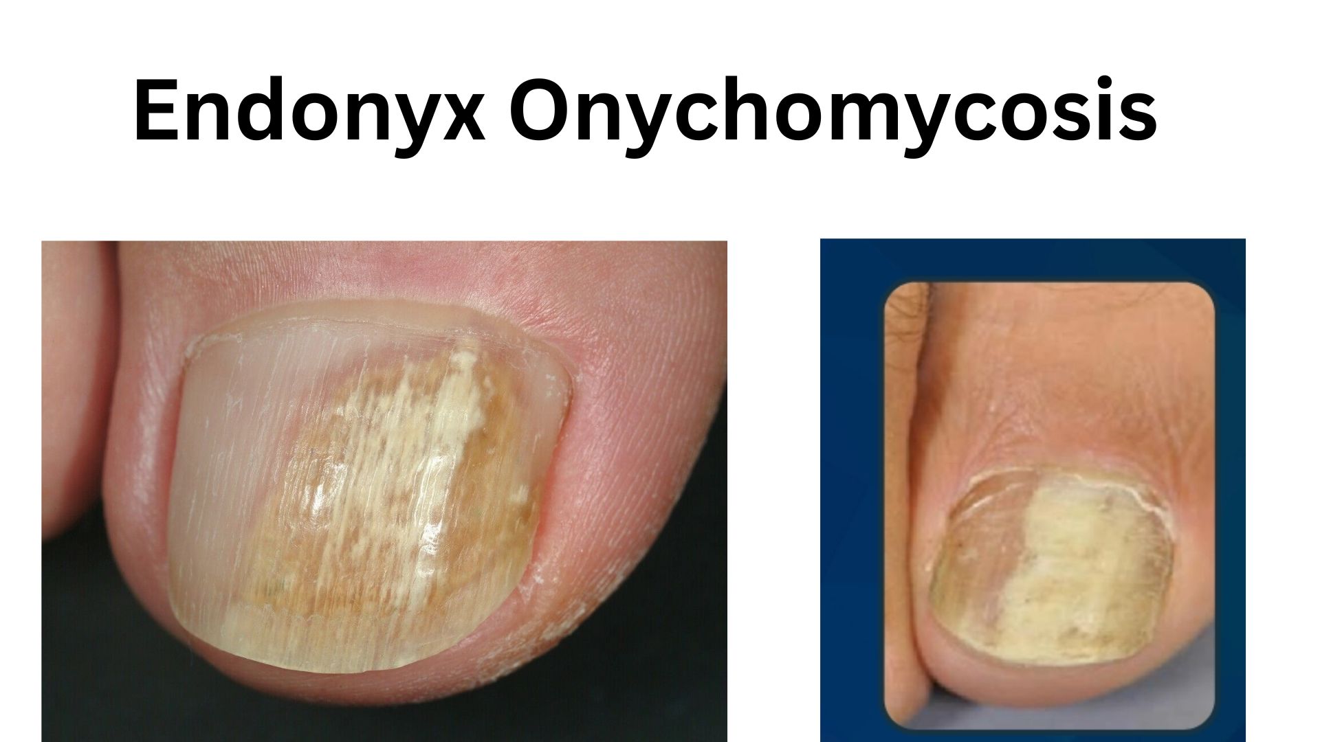 Close-up of a toenail affected by Endonyx Onychomycosis showing thickened and discolored nail with subtle white or yellow patches on the nail bed