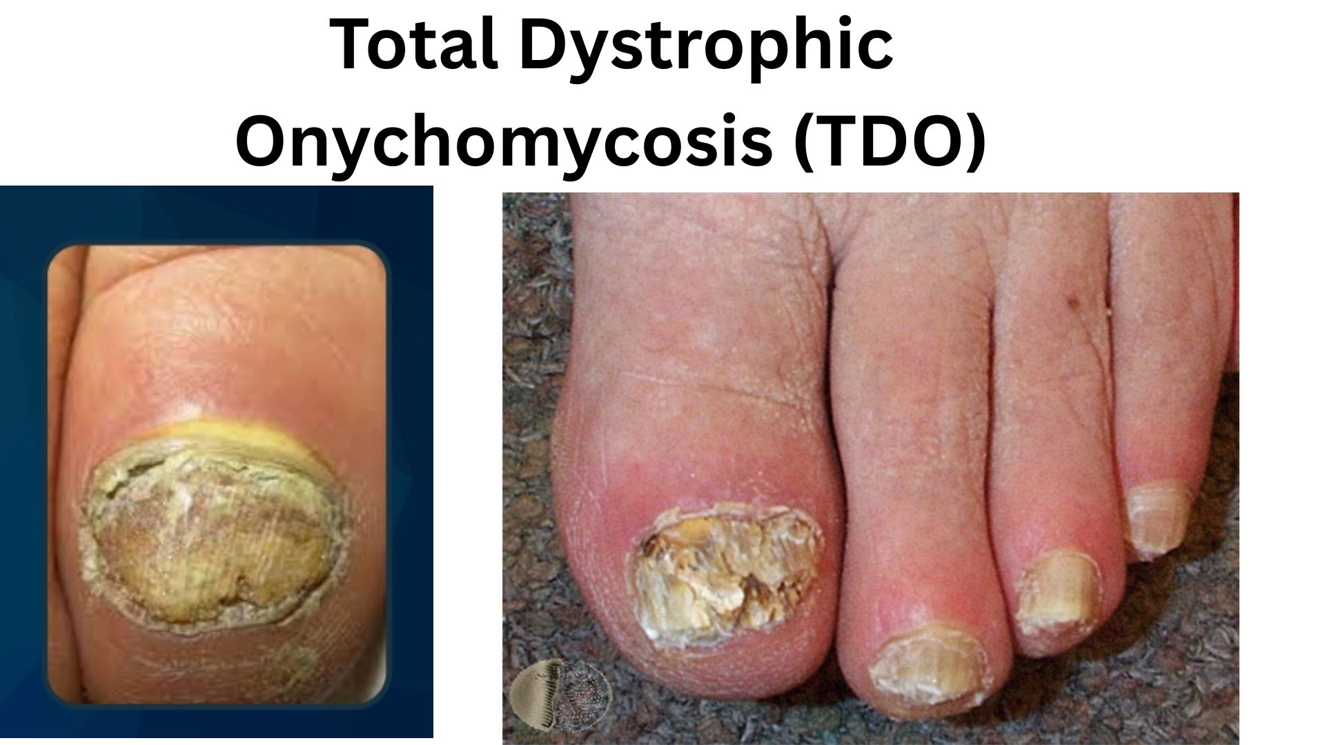 Close-up of a toenail affected by Total Dystrophic Onychomycosis showing complete nail destruction, thickening, brittleness, and discoloration